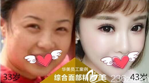 面部精雕手術(shù)前后對(duì)比照片