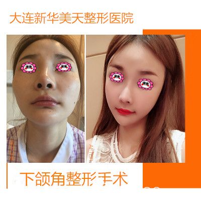 大連新華美天整形下頜骨削骨變化圖