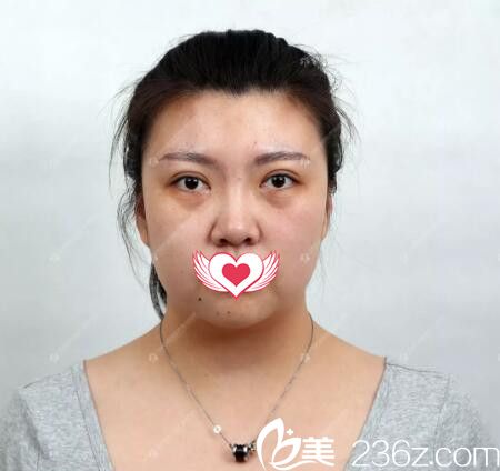 祛眼袋術(shù)前效果 祛眼袋術(shù)前效果