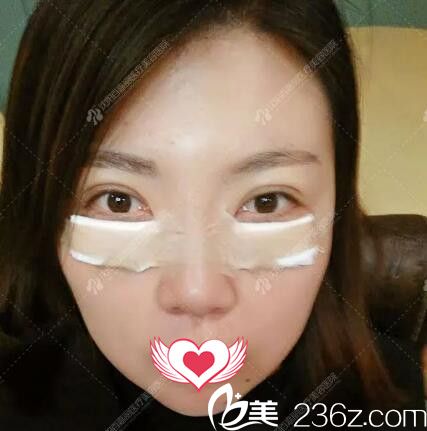 祛眼袋術(shù)后即刻效果 祛眼袋術(shù)后即刻效果