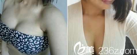 透露我在桂林時光整形做曼托275cc假體隆胸62天恢復(fù)實況，胸部從A直接到C