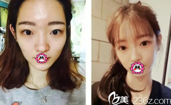 在韓國巴諾巴奇整形術(shù)前顴骨突兀鼻梁塌陷 在韓國巴諾巴奇整形術(shù)前顴骨突兀鼻梁塌陷