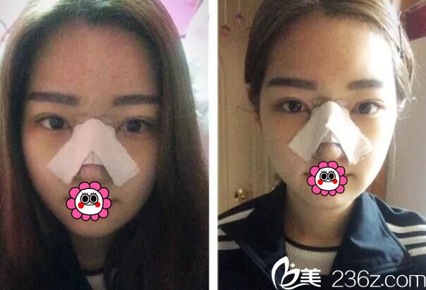 找潘在常院長隆鼻后裹著紗布 找潘在常院長隆鼻后裹著紗布