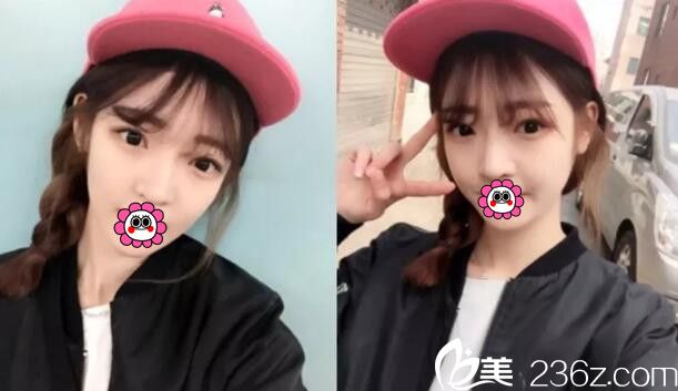 逐漸消腫的輪廓+眼鼻整形 逐漸消腫的輪廓+眼鼻整形