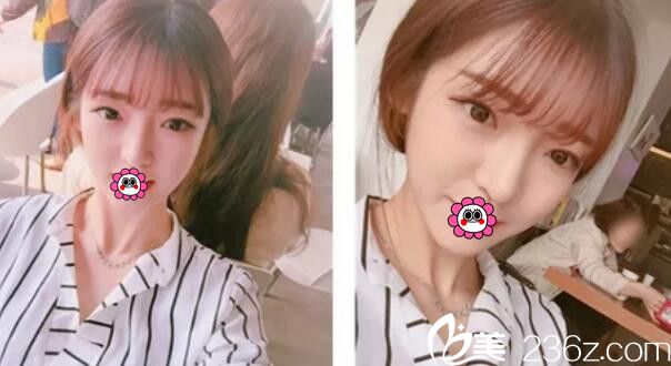 潘在常院長輪廓+眼鼻整形術(shù)后14周 潘在常院長輪廓+眼鼻整形術(shù)后14周