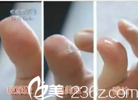 奧美定和玻尿酸的區(qū)別