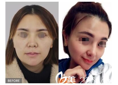 美貝爾“耳軟骨隆鼻精細縫合器”案例展示 美貝爾“耳軟骨隆鼻精細縫合器”案例展示