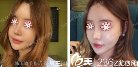 李柱洪鼻綜合一個月左右