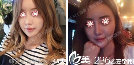 韓國迪美(THE M)整形鼻綜合三個月