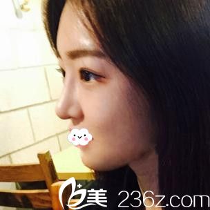 武漢涵美隆鼻整形怎么樣？袁羽鼻綜合案例