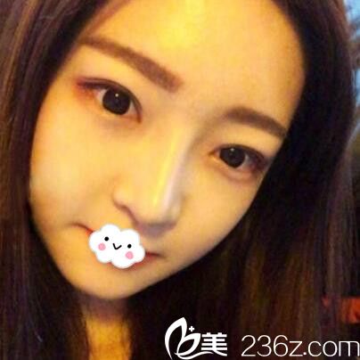 武漢隆鼻整形哪家醫(yī)院好？武漢涵美鼻綜合案例