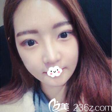 武漢涵美假體隆鼻術(shù)后恢復(fù)效果圖