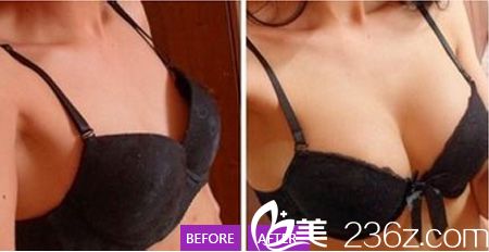 京美整形醫(yī)院隆胸案例 京美整形醫(yī)院隆胸案例