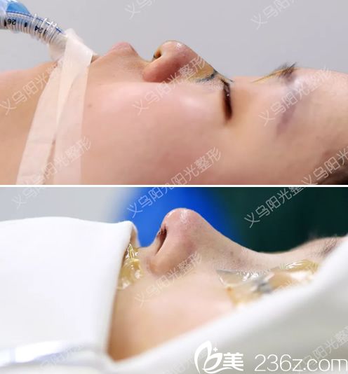 義烏陽光整形醫(yī)院隆鼻<span style=