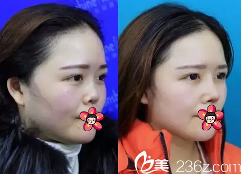 義烏陽光整形隆鼻<span style=