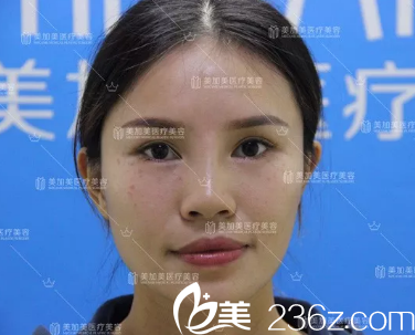 深圳美加美隆鼻案例術(shù)前照片 深圳美加美隆鼻案例術(shù)前照片