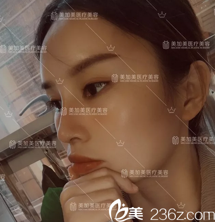 深圳美加美隆鼻案例10天自拍 深圳美加美隆鼻案例10天自拍