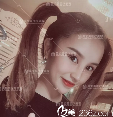 閨蜜看了我在深圳美加美找陳群做的肋軟骨隆鼻修復(fù)和隆胸效果后心動(dòng)了