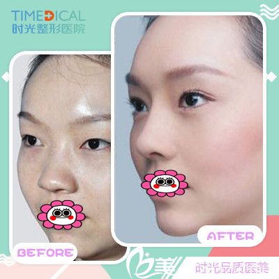 蘭州時光整形雙眼皮效果圖