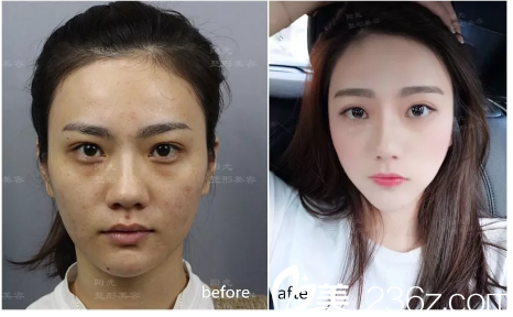 深圳美萊玻尿酸注射填充全臉案例