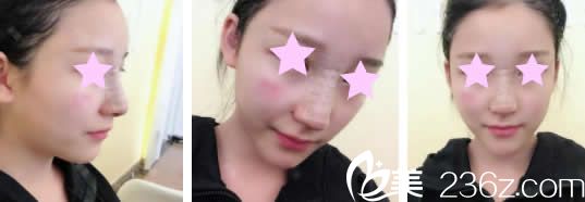 南寧美麗星李武斌給我做鼻綜合術(shù)后第3天照片