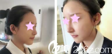 我找美麗星李武斌院長隆鼻術(shù)后第5天照片