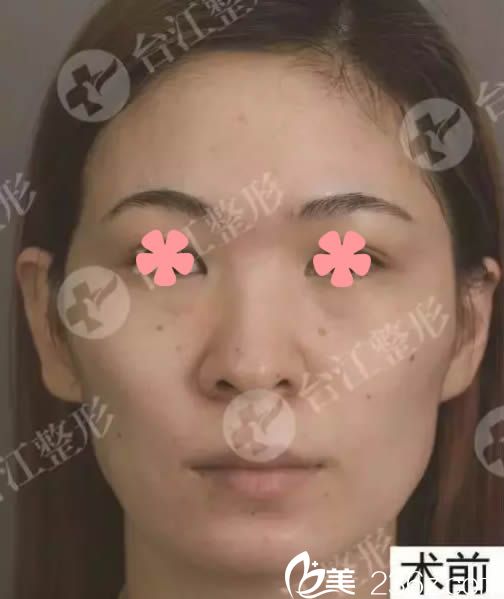 在福州臺江整形醫(yī)院做脂肪填充術(shù)前照 在福州臺江整形醫(yī)院做脂肪填充術(shù)前照