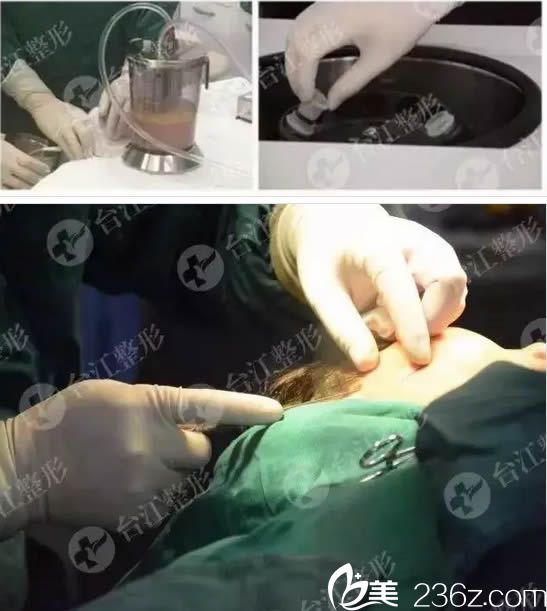 做自體脂肪填充臉手術(shù)過程圖 做自體脂肪填充臉手術(shù)過程圖