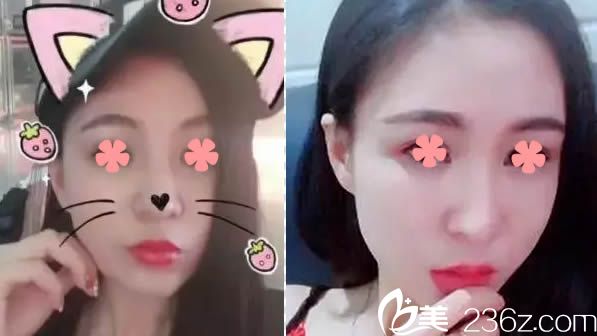 聽說自體脂肪填充全臉很假,但我去福州臺(tái)江讓馬美洲做過全臉脂肪填充后反而變美十倍