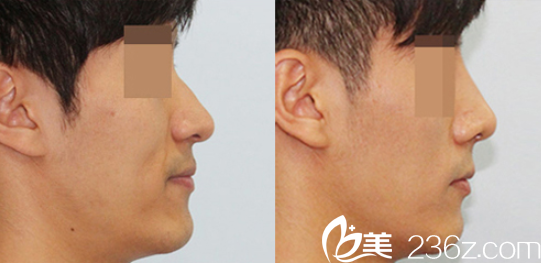 韓國(guó)定佑美容整形駝峰鼻矯正案例圖