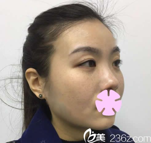 我在南寧愛思特整形做面部吸脂前的照片 我在南寧愛思特整形做面部吸脂前的照片