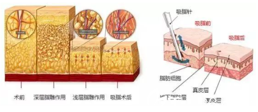 吸脂示意圖 吸脂示意圖