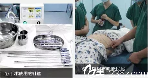 貴陽(yáng)美貝爾SX導(dǎo)航吸脂過程 貴陽(yáng)美貝爾SX導(dǎo)航吸脂過程