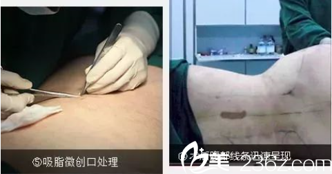 貴陽(yáng)美貝爾吸脂技術(shù)好不好 貴陽(yáng)美貝爾吸脂技術(shù)好不好