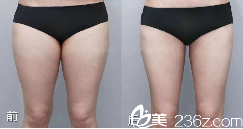 貴陽(yáng)美貝爾吸脂效果怎么樣 貴陽(yáng)美貝爾吸脂效果怎么樣