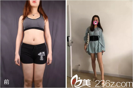 貴陽(yáng)美貝爾腰腹部大腿吸脂案例 貴陽(yáng)美貝爾腰腹部大腿吸脂案例