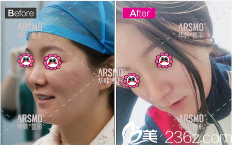 北京華韓虞守輝注射微整案例