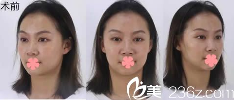 在福州名韓整形醫(yī)院做隆鼻前的蒜頭鼻照片 在福州名韓整形醫(yī)院做隆鼻前的蒜頭鼻照片