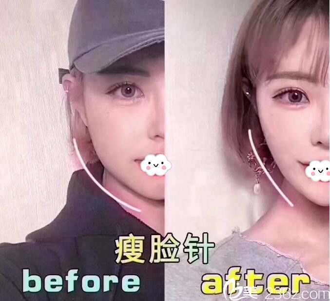 荊門和麗醫(yī)療美容注射瘦臉案例效果對比圖 荊門和麗醫(yī)療美容注射瘦臉案例效果對比圖