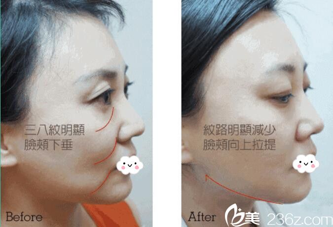 荊門和麗面部線雕埋線提升真人案例 荊門和麗面部線雕埋線提升真人案例