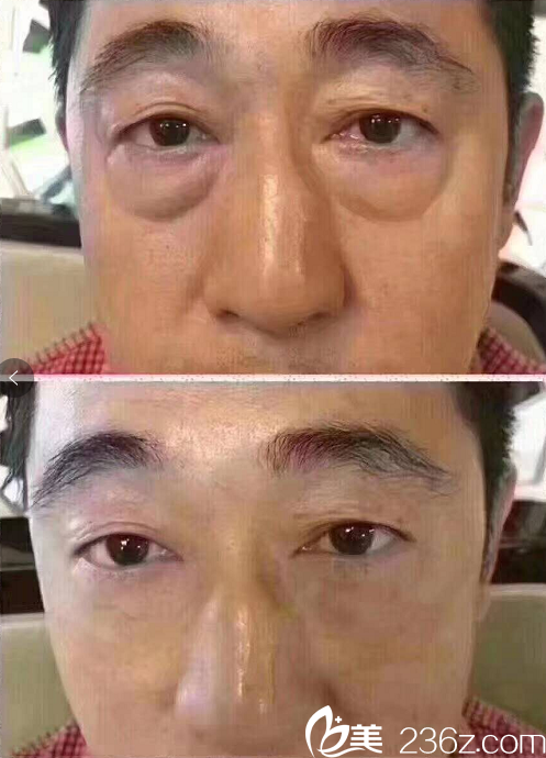 荊門和麗去眼袋案例前后效果對比圖 荊門和麗去眼袋案例前后效果對比圖