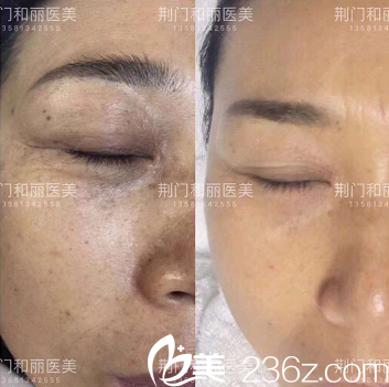 荊門和麗醫(yī)療美容激光祛斑真人案例 荊門和麗醫(yī)療美容激光祛斑真人案例