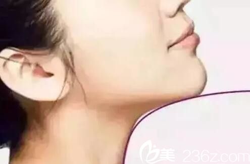 玻尿酸隆下巴多久能恢復(fù)自然？