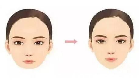 玻尿酸隆下巴前后效果對比