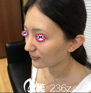 在北京美萊做玻尿酸全臉填充前樣子 在北京美萊做玻尿酸全臉填充前樣子