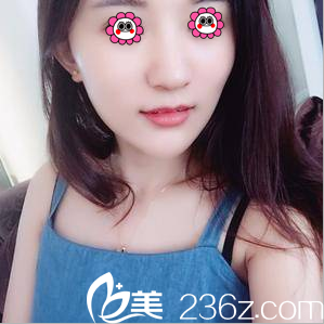 周福田醫(yī)生給我做玻尿酸全面部填充第7天效果 周福田醫(yī)生給我做玻尿酸全面部填充第7天效果