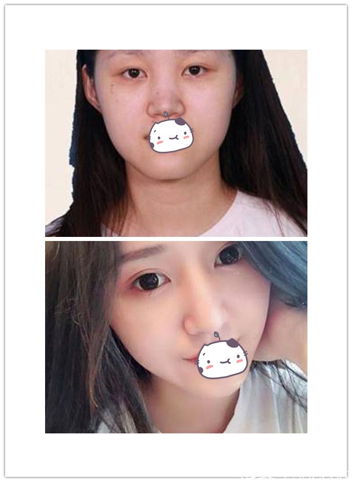 洛陽華美醫(yī)院王旭明隆鼻案例 洛陽華美醫(yī)院王旭明隆鼻案例