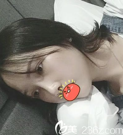 做完耳軟骨隆鼻和雙眼皮2月后