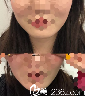 注射瘦臉除皺前后對比案例