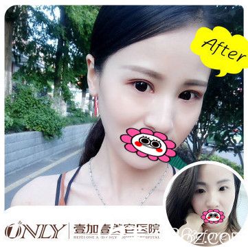 合肥壹加壹甘泉涌雙眼皮前后效果圖